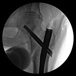 Left hip jatrogenic fracture fixation failure